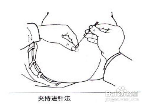 平衡针灸进针手法视频