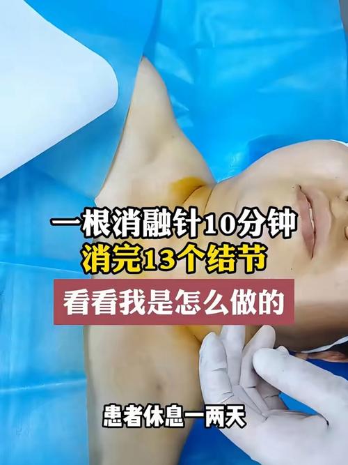 甲状腺结节针灸好使吗