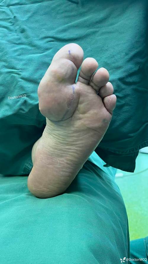 痛风石手术后多久愈合