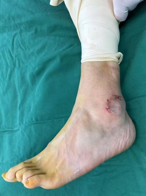 痛风石手术后多久愈合