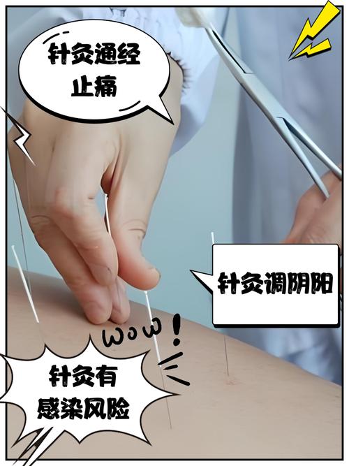 针灸可以连续扎一年吗