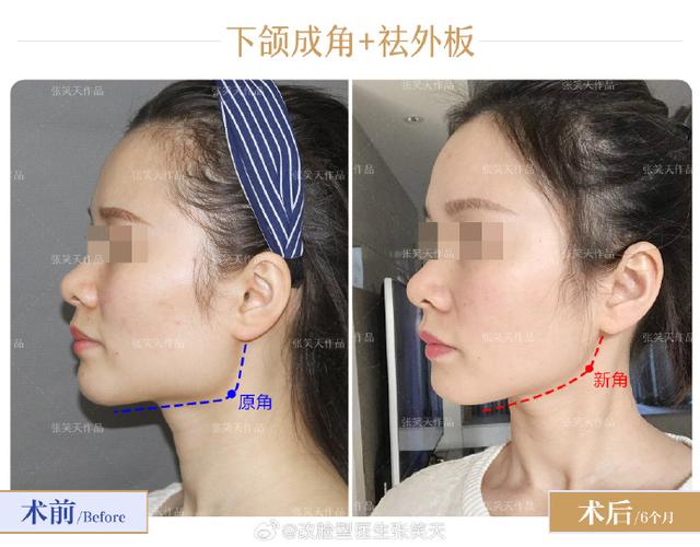 下颌角磨骨手术安全吗