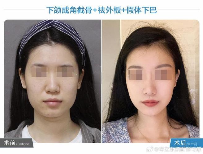 下颌角磨骨手术安全吗