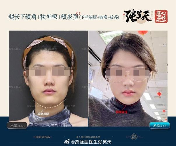 下颌角磨骨手术安全吗