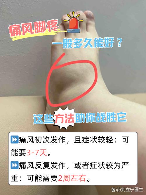 痛风严重吗多久才能好