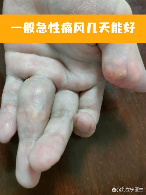 痛风严重吗多久才能好