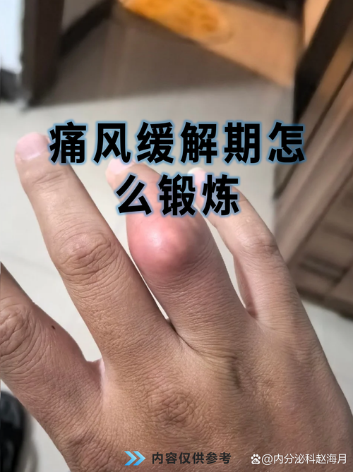 痛风严重吗多久才能好