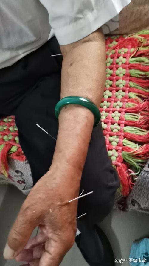 类风湿关节炎针灸治疗