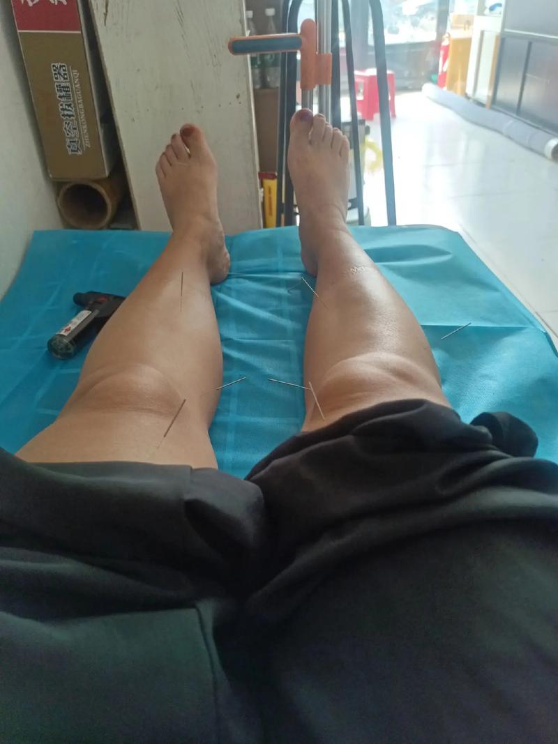 腿疼针灸三次就不疼了
