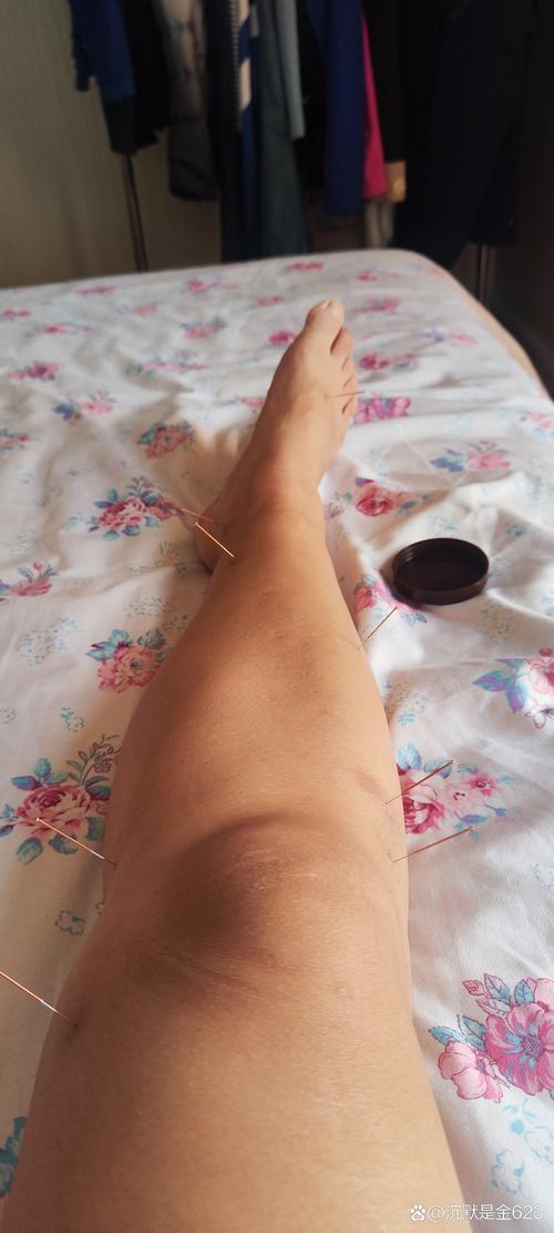 腿疼针灸三次就不疼了