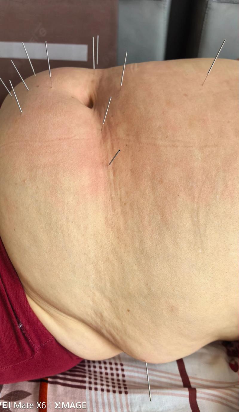 广安门中医院针灸减肥