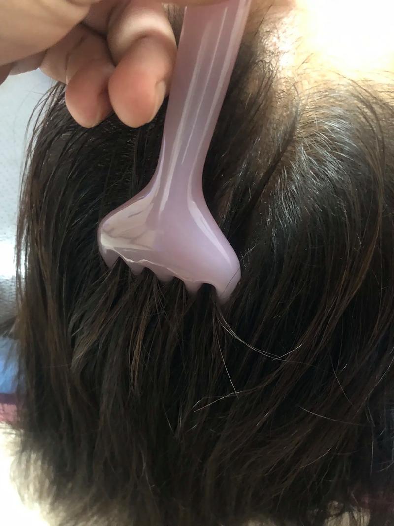 腰椎间盘突出针灸有效