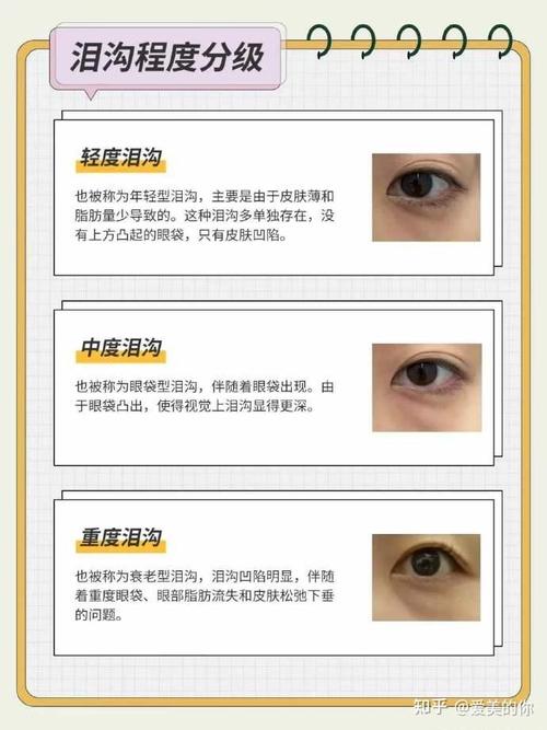 玻尿酸泪沟填充安全么