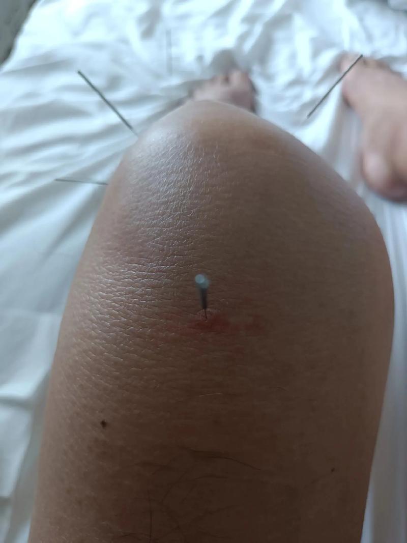 针灸治疗膝关节滑膜炎
