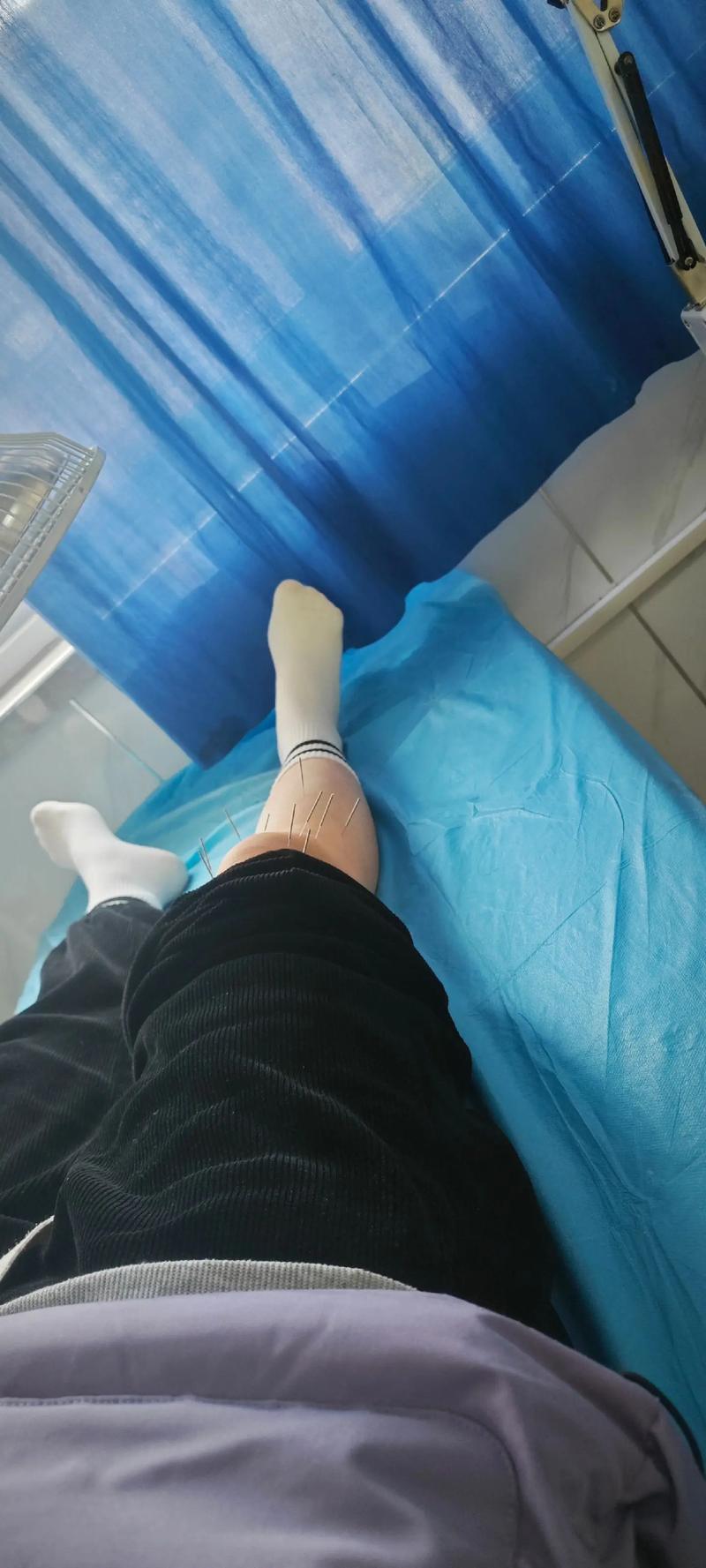 针灸治疗膝关节滑膜炎