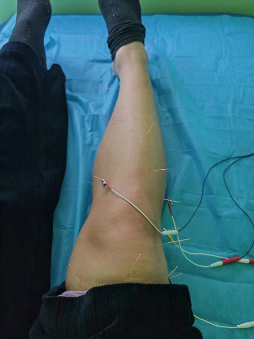 针灸治疗膝关节滑膜炎