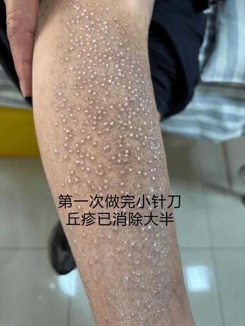 针灸治疗皮肤病有奇效