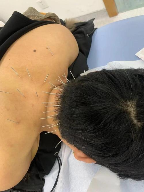 针灸治疗皮肤病有奇效