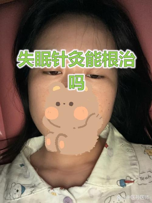 针灸治疗失眠会复发吗