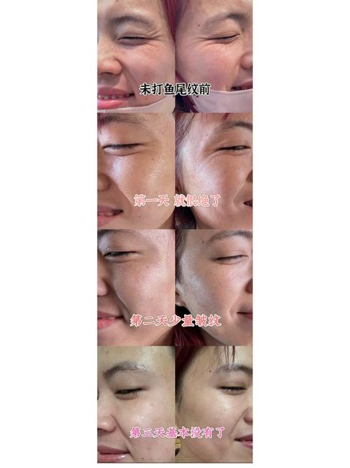 保妥适面部除皱安全吗