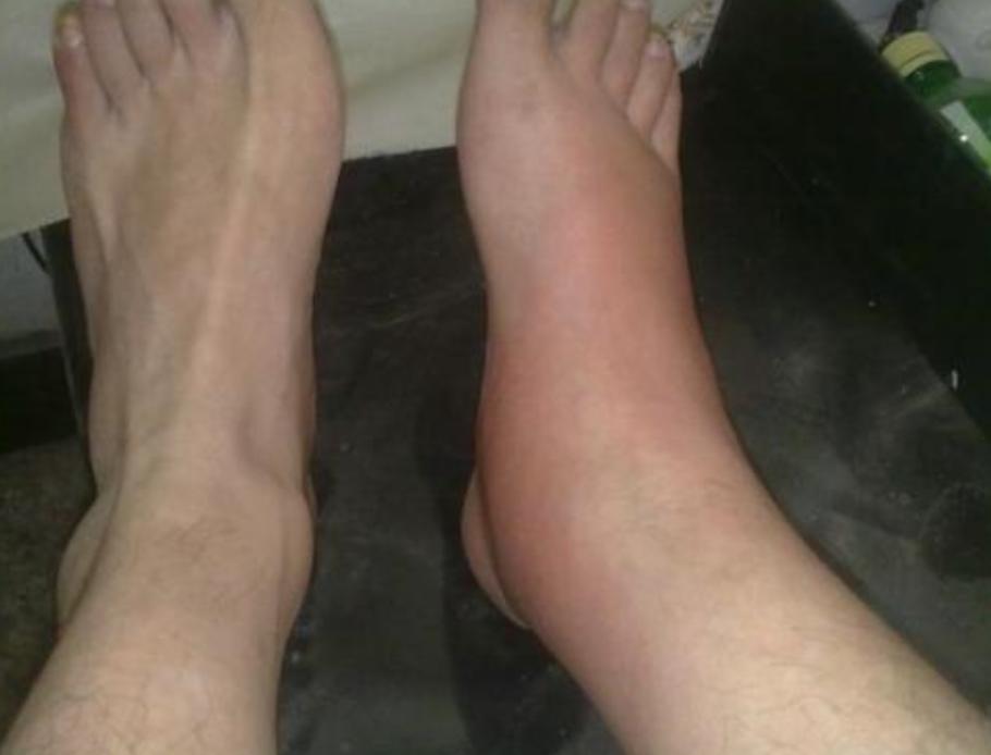 痛风一个月脚还隐隐痛