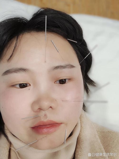 针灸治疗面瘫多久见效