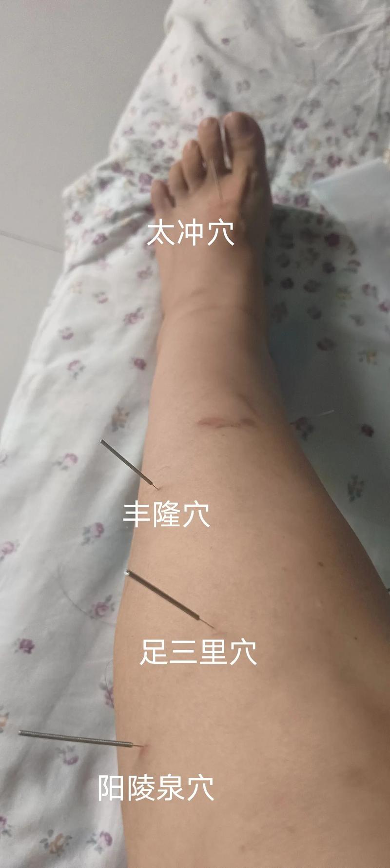 脑供血不足针灸有用吗