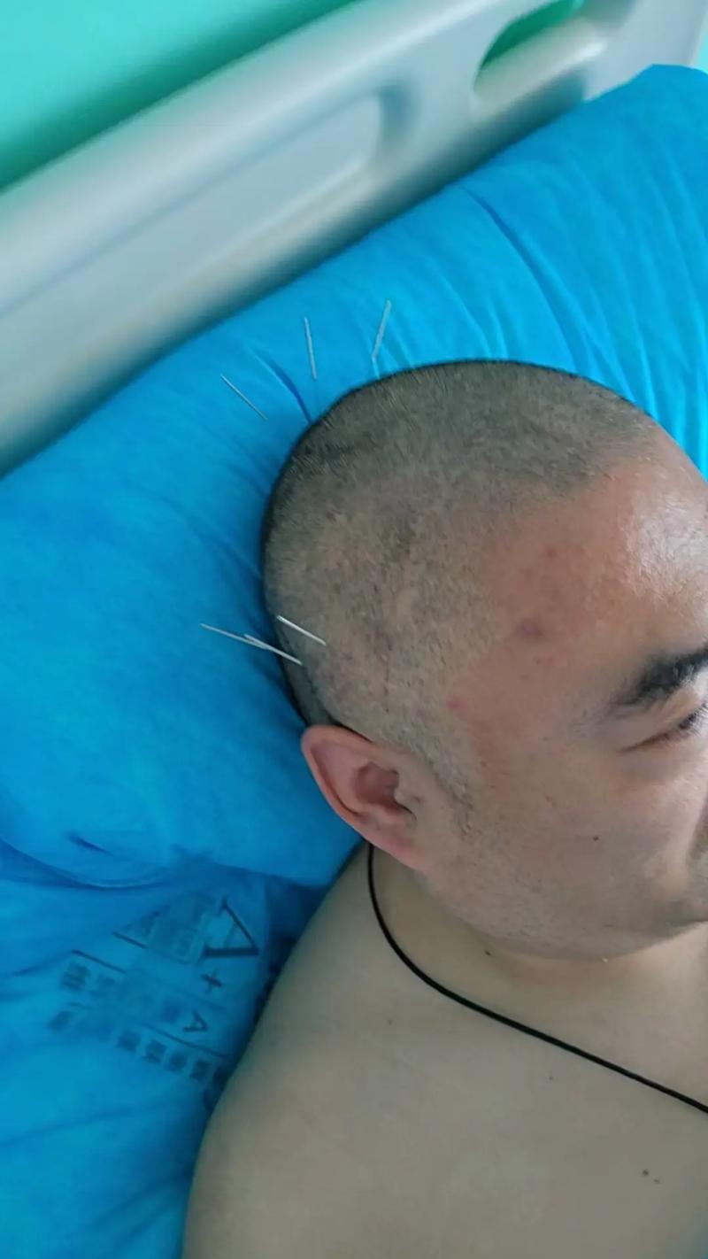 脑供血不足针灸有用吗