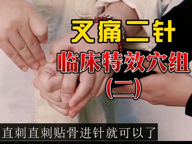 三叉神经疼针灸扎哪里