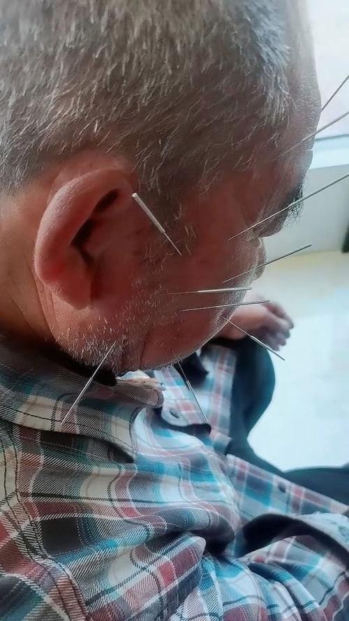 三叉神经疼针灸扎哪里