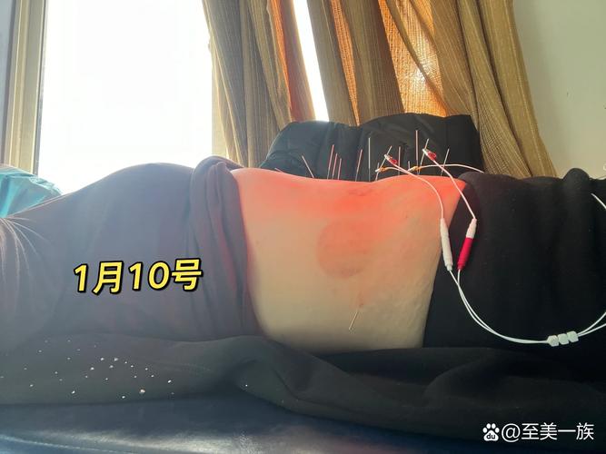针灸减肥一月能瘦多少