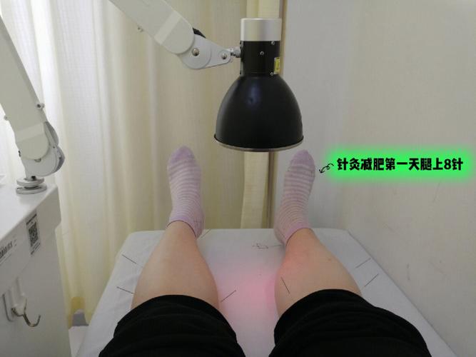 针灸减肥一月能瘦多少