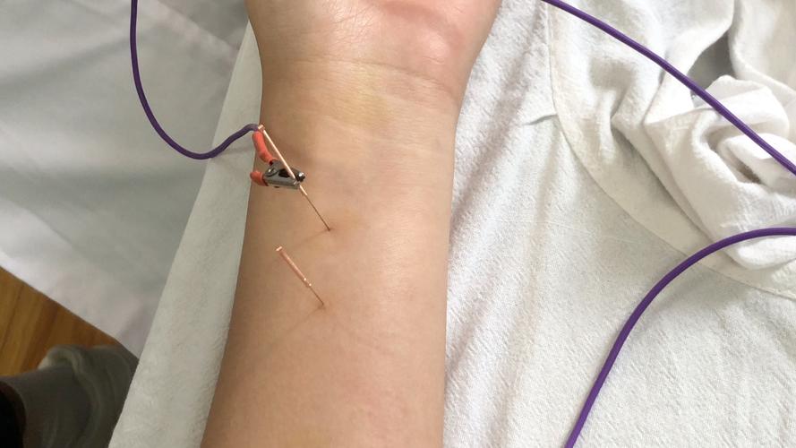 电针疗法和针灸的区别