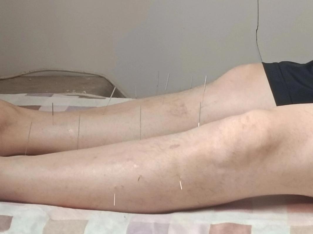 一天最佳针灸减肥时间