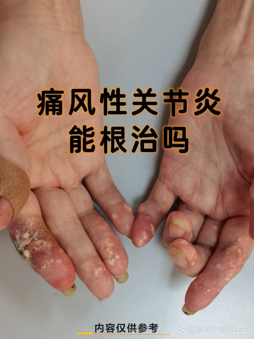 痛风性关节炎多久能好