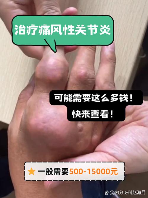 痛风性关节炎多久能好