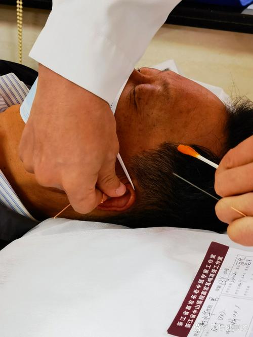 耳鸣做针灸效果好不好