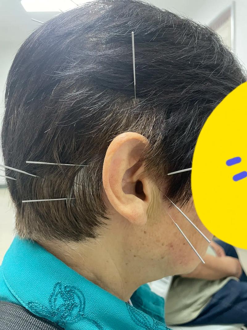 耳鸣做针灸效果好不好