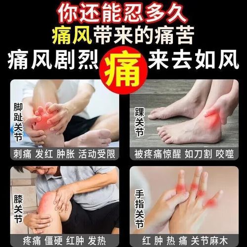 碳酸氢钠可以治痛风吗