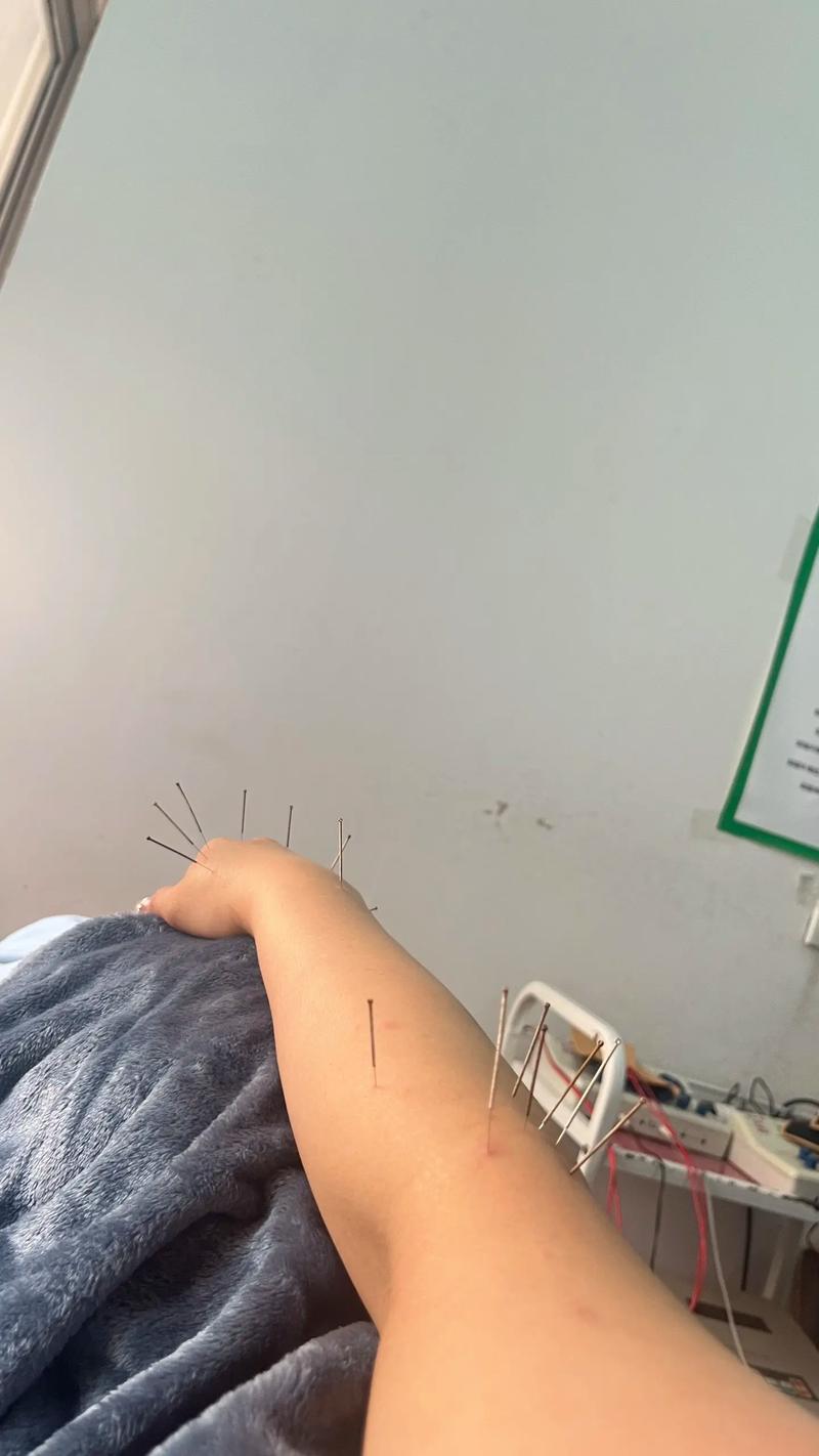 去针灸最好穿什么衣服