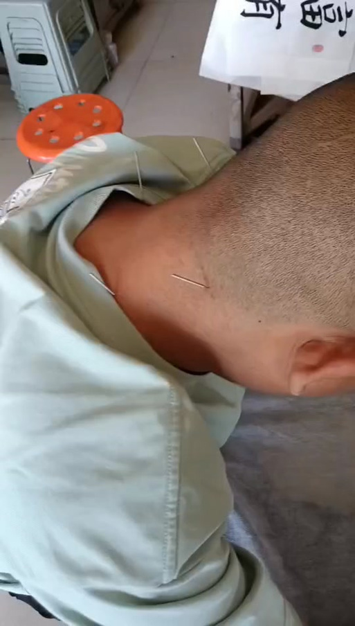 半身不遂针灸视频播放