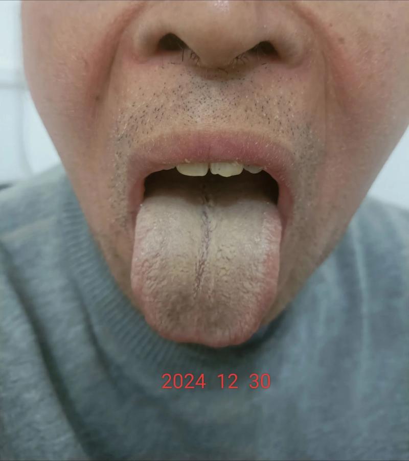 针灸后什么是好转反应