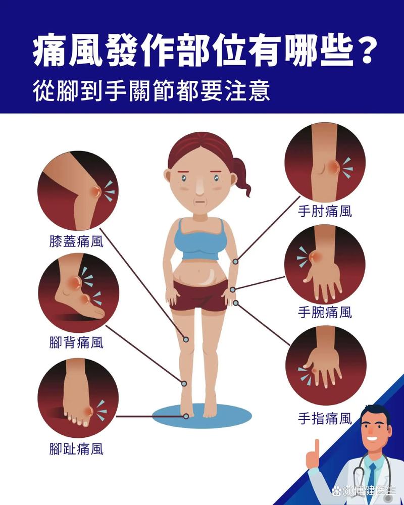 痛风性关节炎怎么缓解