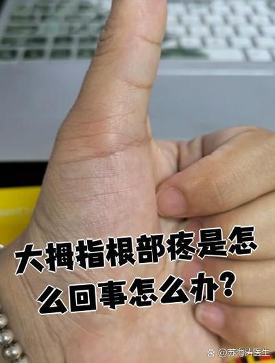 大拇指关节疼是痛风吗