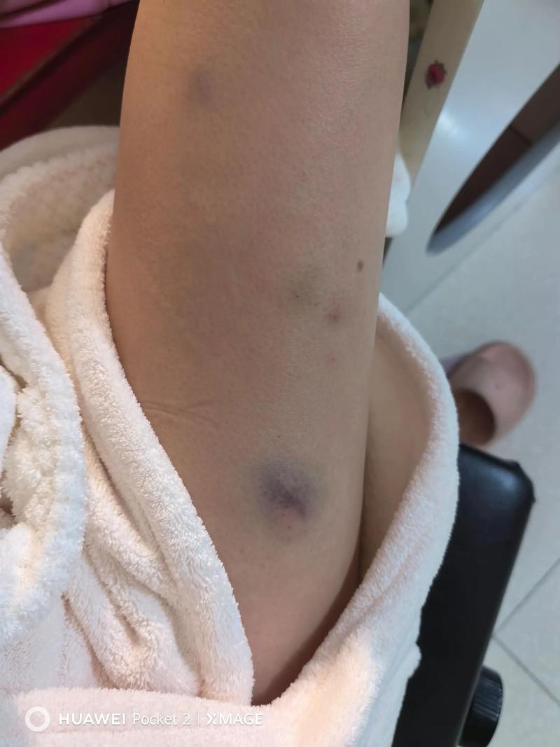 针灸完同房有什么后果