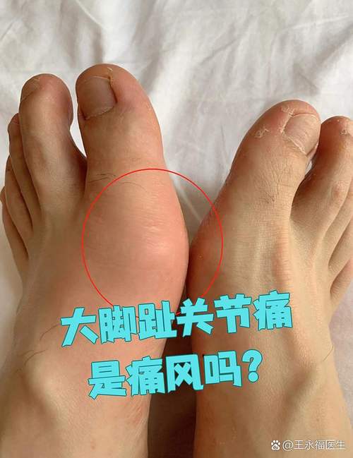 脚痛风一般在什么部位