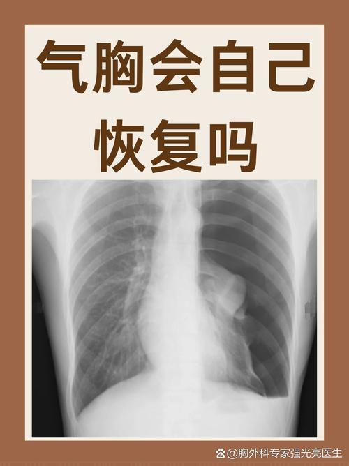 什么是针灸引发的气胸