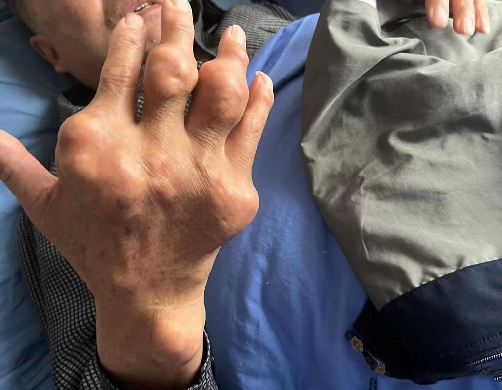 痛风发展到后期是怎样