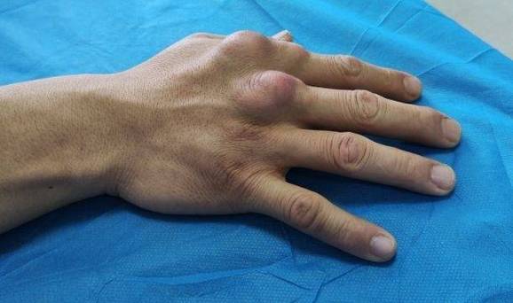 痛风发展到后期是怎样