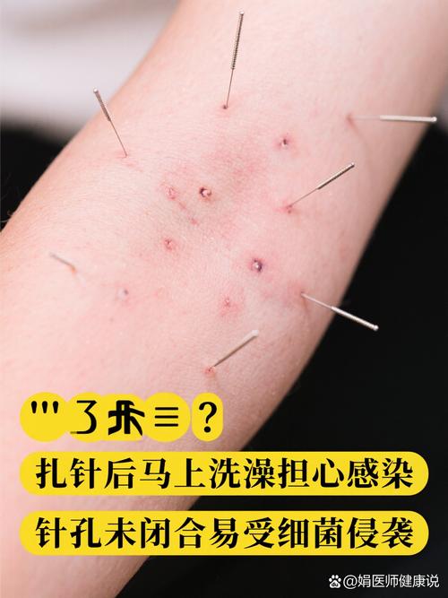 针灸用的银针怎么消毒